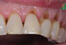 3 aliments qui détruisent nos dents