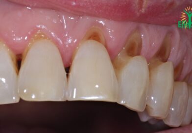 3 aliments qui détruisent nos dents
