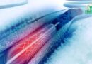 L&rsquo;insertion d&rsquo;un stent : Comprendre l&rsquo;intervention