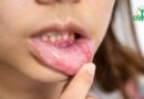Ulcères de la bouche : Causes, Symptômes, Traitements et Prévention