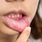 Ulcères de la bouche : Causes, Symptômes, Traitements et Prévention