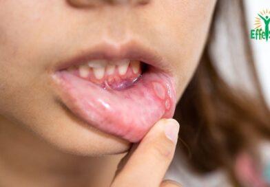 Ulcères de la bouche : Causes, Symptômes, Traitements et Prévention