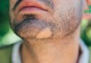 La pelade: une maladie auto-immune