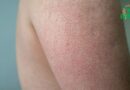 Kératose pilaire – de quoi s&rsquo;agit-il ?