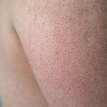 Kératose pilaire – de quoi s&rsquo;agit-il ?