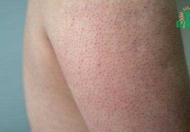 Kératose pilaire – de quoi s&rsquo;agit-il ?