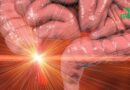 L&rsquo;appendicectomie dévoilée : ce à quoi vous devez vous attendre