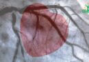Les arythmies cardiaques : Comprendre les irrégularités du rythme cardiaque
