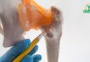Chirurgie du Fémur: Comprendre le Fixateur d&rsquo;Ilizarov