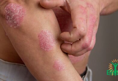 Comprendre et gérer le psoriasis