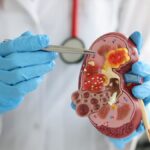 Insuffisance Rénale: Causes, Symptômes, Diagnostic et Traitement