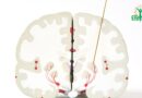 Alimentation et la Maladie de Parkinson
