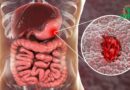 Ulcères gastriques : Causes, symptômes et options de traitement