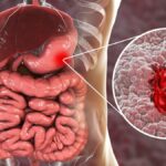Ulcères gastriques : Causes, symptômes et options de traitement
