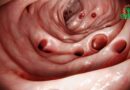 La Diverticulose : Comprendre, Prévenir et Gérer