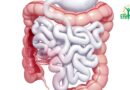 La colopathie fonctionnelle : Comprendre et Gérer