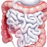 La colopathie fonctionnelle : Comprendre et Gérer