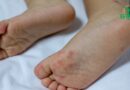 Maladie pieds-mains-bouche