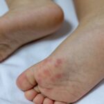 Maladie pieds-mains-bouche