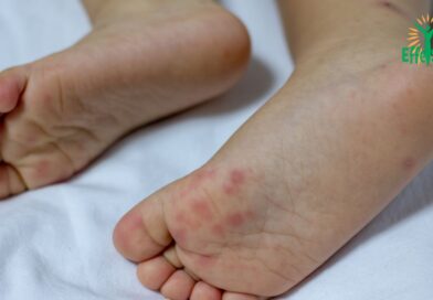 Maladie pieds-mains-bouche