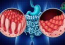 La maladie de Crohn : Tout ce que vous devez savoir