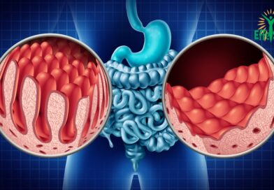 La maladie de Crohn : Tout ce que vous devez savoir