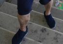 Insuffisance Veineuse et Varices : 15 Faits Insoupçonnés