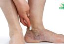 Complications des Varices : Au-delà des Veines Apparentes