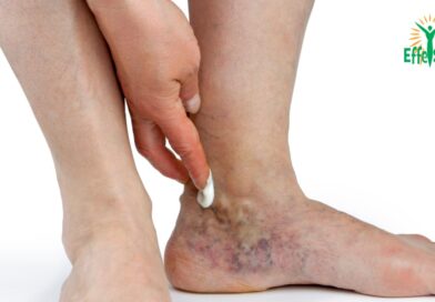 Complications des Varices : Au-delà des Veines Apparentes