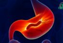 Gastrite à l&rsquo;Helicobacter pylori : Faits étonnants et méconnus