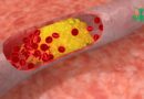 Hypercholestérolémie Familiale : Une Lutte Génétique Contre le Cholestérol ⚖️🧬