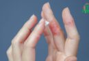 Eczéma : Plongée au cœur de la Dermatite Atopique