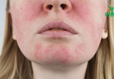 Rosacée: Comment soigner ? Conseils et Remèdes