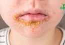 Impétigo: comprendre cette maladie de la peau
