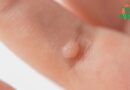Verrues: comprendre cette maladie de la peau
