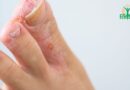 Pied d&rsquo;athlète: Infection fongique de la peau