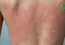 Urticaire: Comprendre cette maladie de la peau
